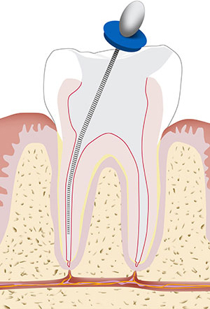 Zahnwurzelbehandlung, Endodontie 2